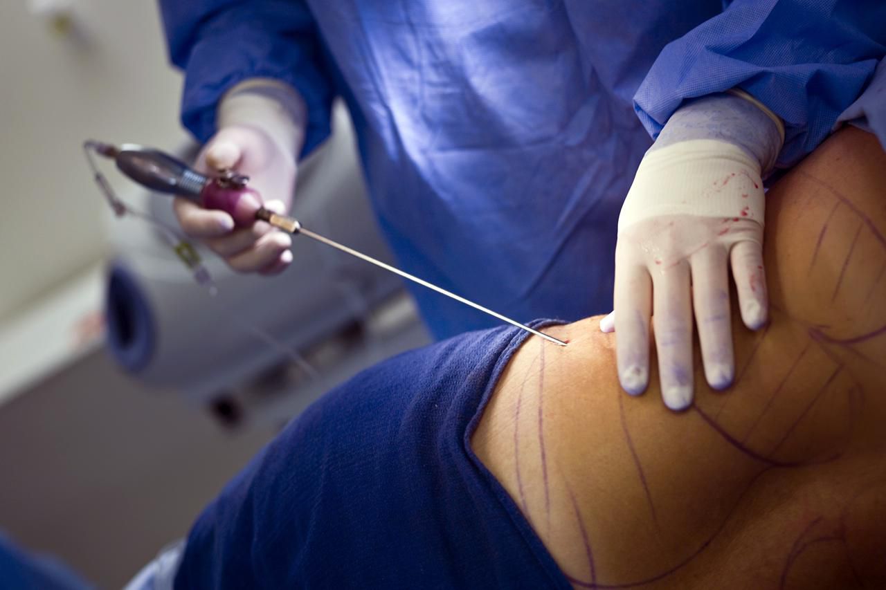 liposuction in islamabad